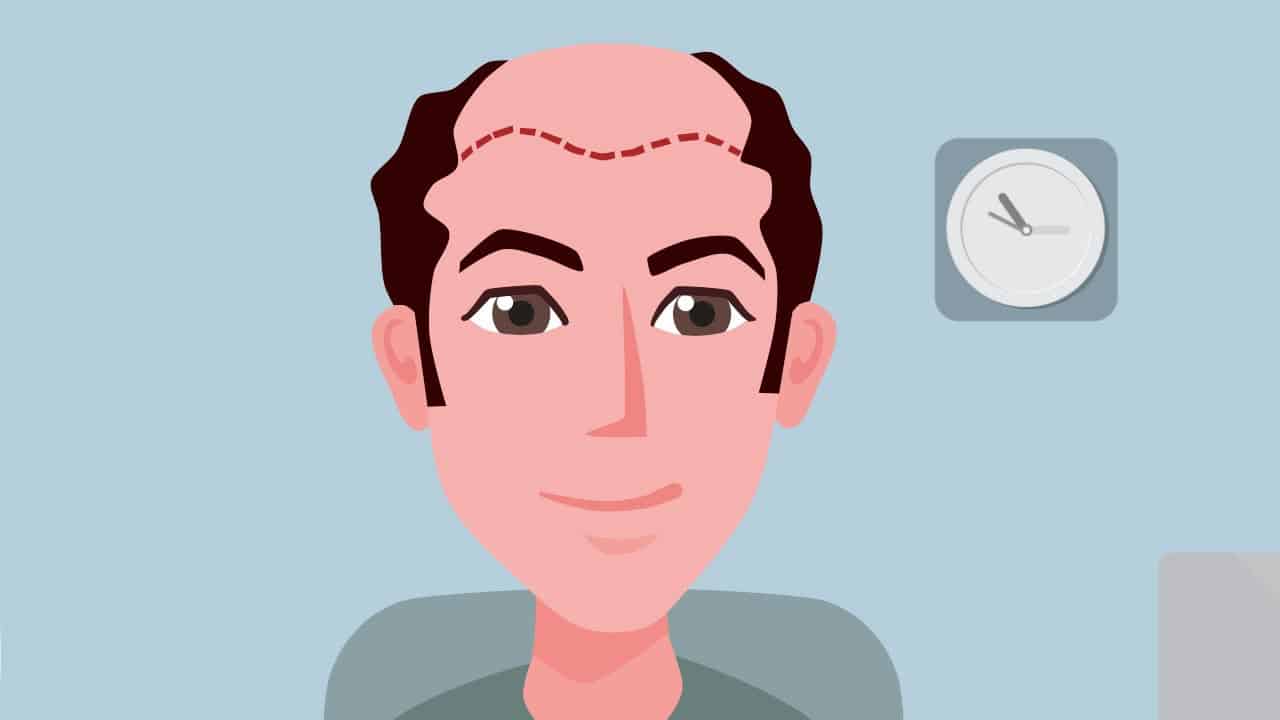 Essential Considerations Before Selecting a Hair Transplant Clinic